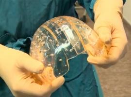 Впервые в мире: пациенту из Нидерландов пересадили 3D-печатный имплантат черепа