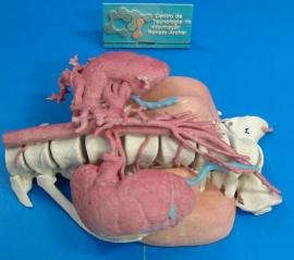 Технология 3D-печати помогла хирургам удалить опухоль и 5 позвонков у 12-летней девочки