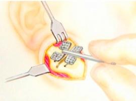 Новости 3D-печатного бизнеса: 3D Systems купила компанию Medical Modeling, чтобы выйти на рынок реконструктивной хирургии