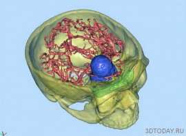 В Китае проведена успешная операция по удалению опухоли с помощью 3D-печати В Китае проведена успешная операция по удалению опухоли с помощью 3D-печати