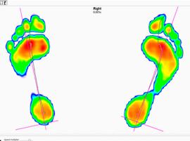 Первые в мире динамические 3D-печатные стельки для профессиональных спортсменов и обычных людей 