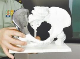 Китайские врачи напечатали и имплантировали кости плеча и таза