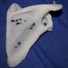 Хирурги провели успешную операцию на плече пациентки благодаря 3D-печати