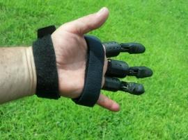 3D-печатные пальцы подарили надежду жертве несчастного случая