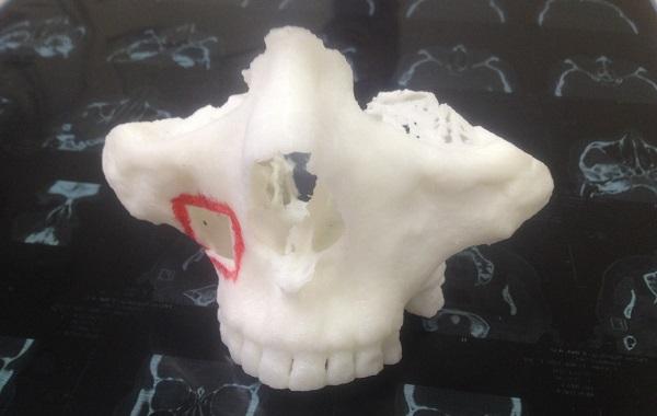 ТюмГУ снабжает сибирских врачей 3D-печатными хирургическими моделями