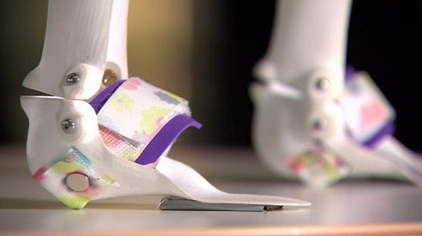 Компания AbilityMate изготовила 3D-печатные «сапоги-скороходы» для девочки с церебральным параличом