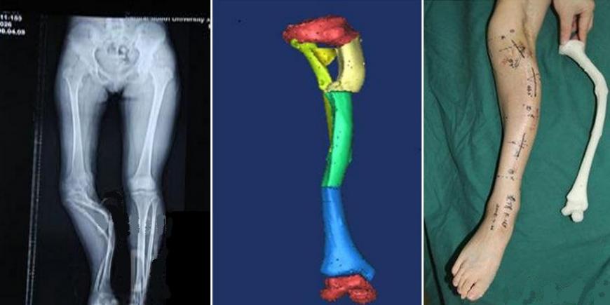 Хирурги прибегли к помощи 3D-печати, чтобы выпрямить искривленную ногу пациентки