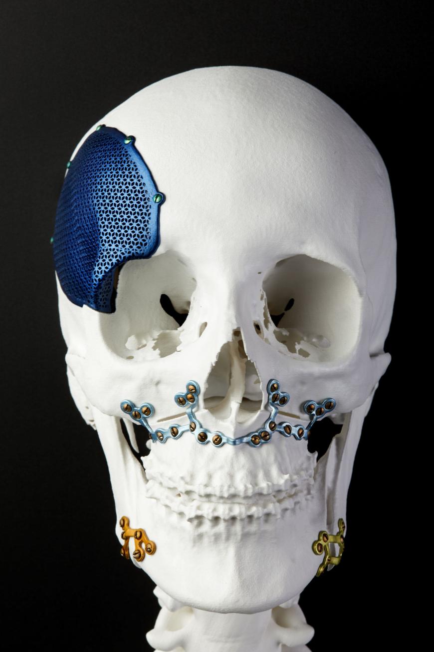 Медицинские 3D-принтеры металлом Concept Laser кардинально меняют реконструктивную хирургию