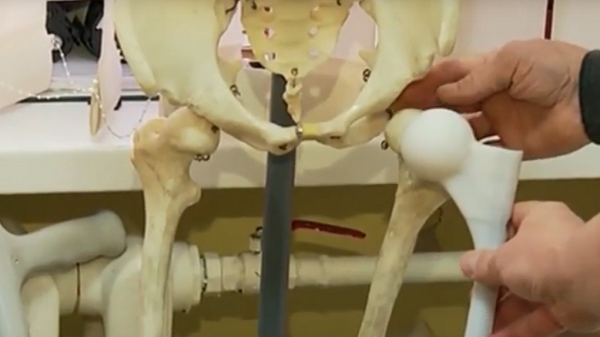 3D-печатный эндопротез помог поставить на ноги 67-летнего тюменского спортсмена
