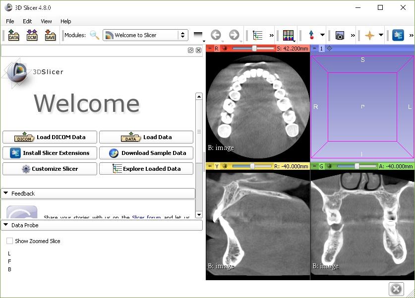 Конвертация снимков МРТ (формата DICOM) в STL формат