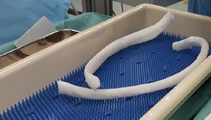 Болгарские врачи вживили 3D-печатное ребро из полиамида