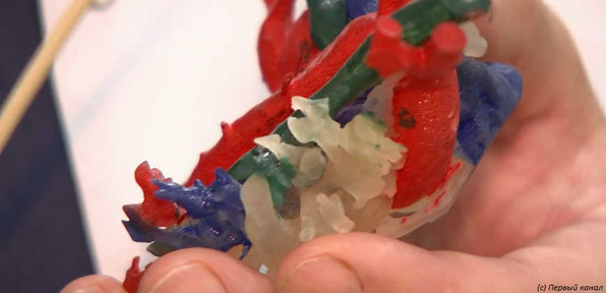 3D-печать помогла столичным врачам спланировать операцию на трехлетнем ребенке