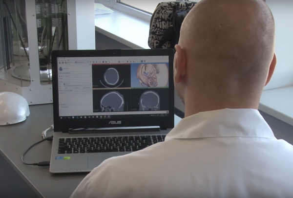 Волгоградские нейрохирурги вживили изготовленный в помощью 3D-технологий имплантат