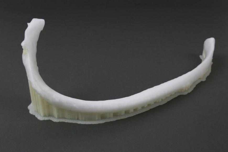 Протез ребра, напечатанный на 3D-принтере, успешно имплантировали в тело человека
