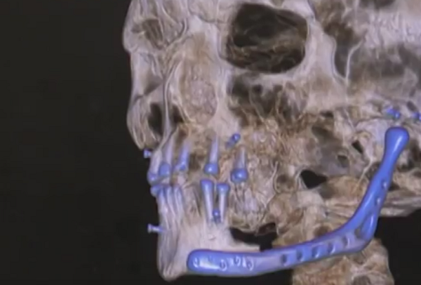Красноярские хирурги провели операцию по вживлению напечатанного на 3D-принтере протеза челюсти