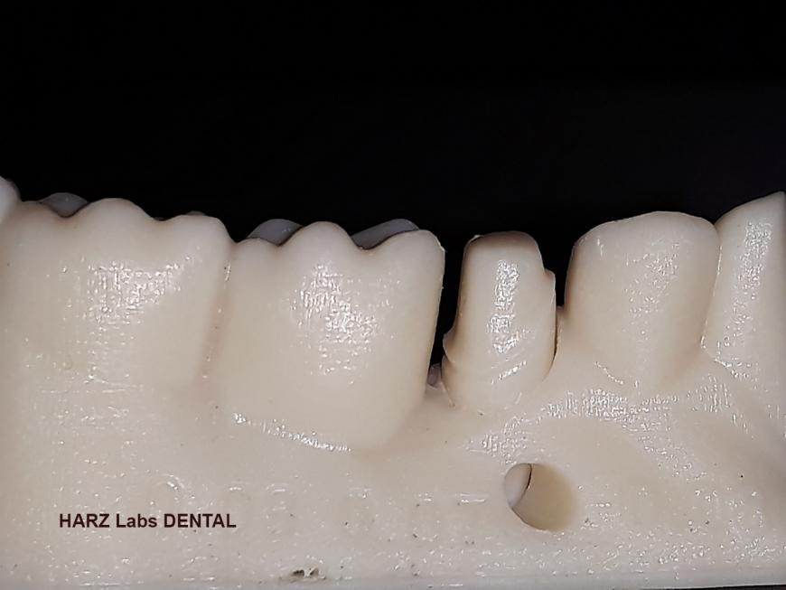 HARZ Labs DENTAL SAND A1-A2 Пробная печать кусалок и жевалок. UNIZ PLUS
