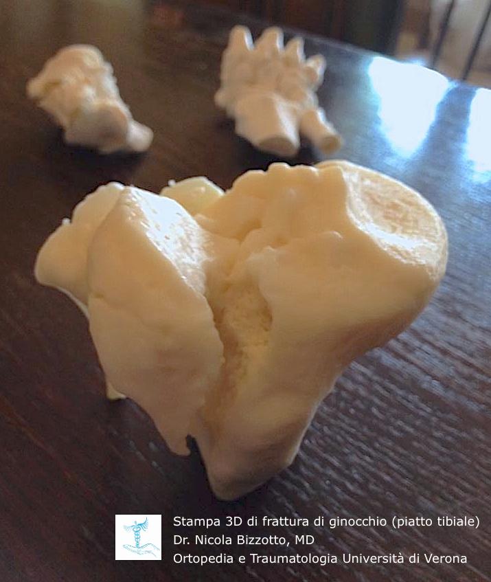 Итальянские хирурги печатают на 3D-принтере копии переломов для успешного проведения операции