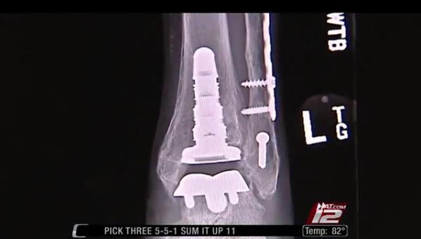 Женщине из Техаса установили протез лодыжки, напечатанный на 3D-принтере