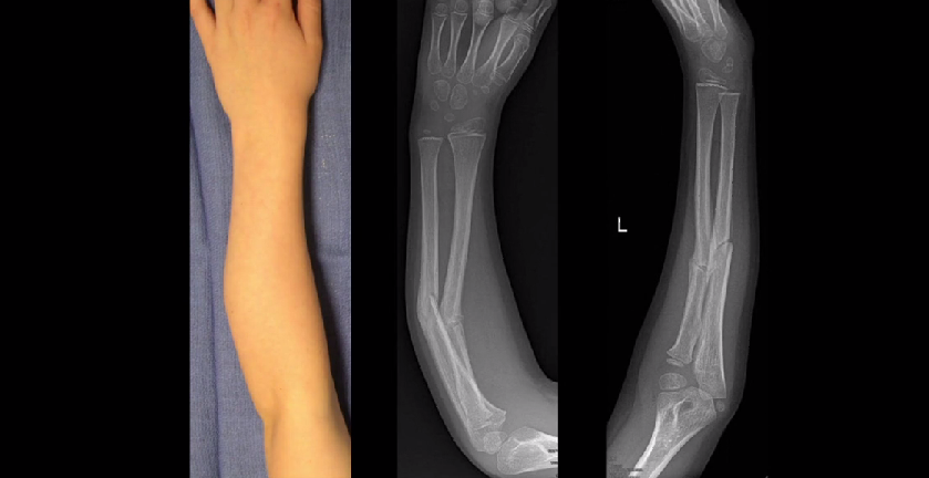 Бельгийский хирург и специалисты Materialise восстановили руку 7-летнего мальчика после перелома