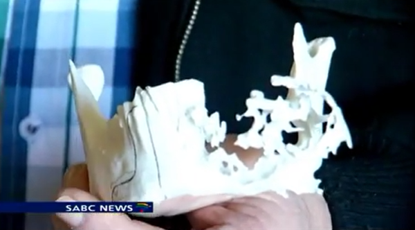 Двум раковым больным из Южной Африки установили напечатанные на 3D-принтере протезы челюсти