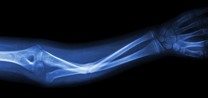 Ученые нашли способ улучшить 3D-печатные костные трансплантаты