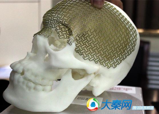 Врачи восстановили форму черепа пациента с помощью 3D-печатной титановой сетки