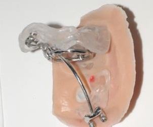 3D-печатный челюстно-лицевой протез для ракового больного