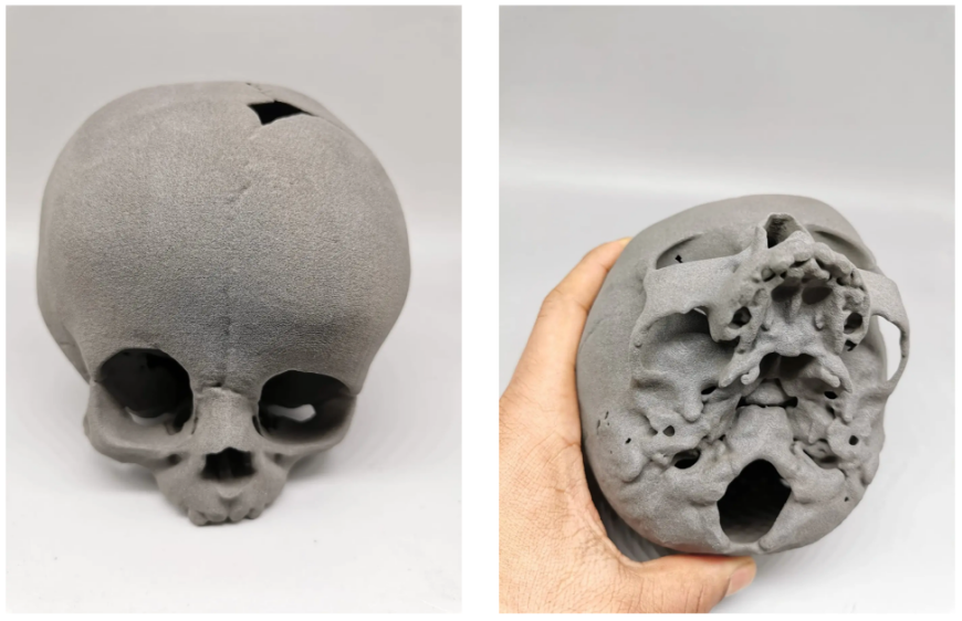 От анатомических моделей к хирургическим шаблонам: преимущества 3D-печати в черепно-челюстно-лицевой хирургии