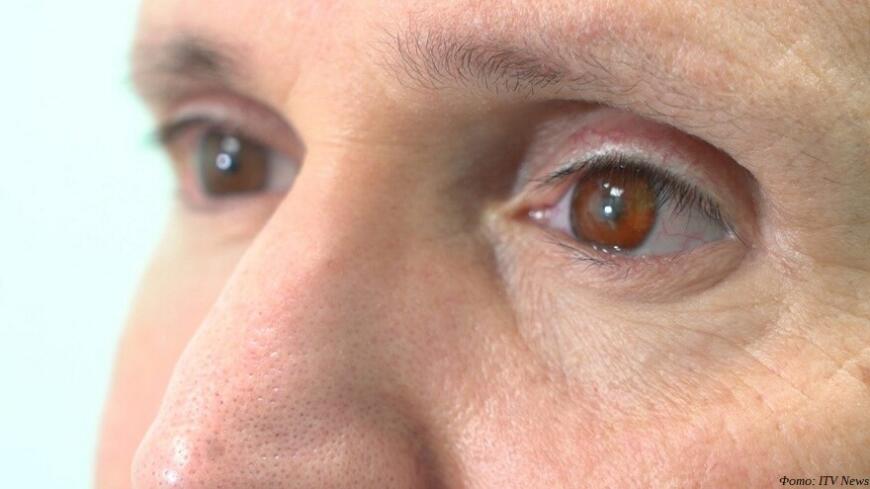 Британский пациент получил 3D-печатный глазной протез