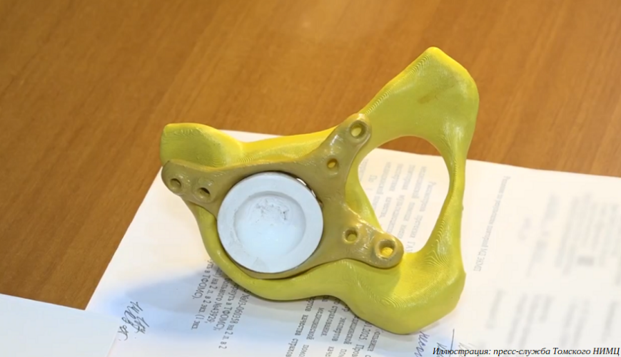 Томские онкологи применяют 3D-печатные имплантаты из поливинилиденфторида
