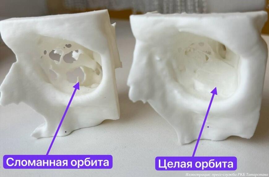 В Республиканской клинической больнице Татарстана восстановили орбиту глаза с помощью 3D-технологий В Республиканской клинической больнице Татарстана восстановили орбиту глаза с помощью 3D-технологий