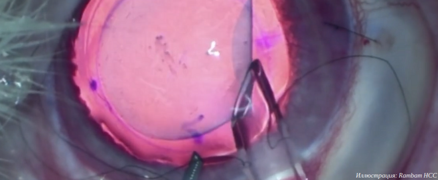 Израильские врачи вернули слепой пациентке зрение с помощью 3D-печатной роговицы