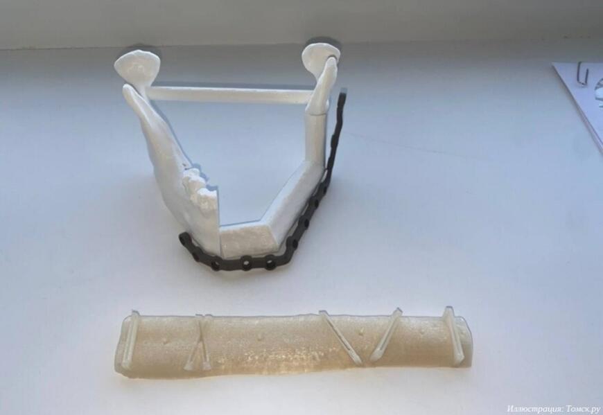 Томские онкологи восстановили челюсть пациента с помощью 3D-печати