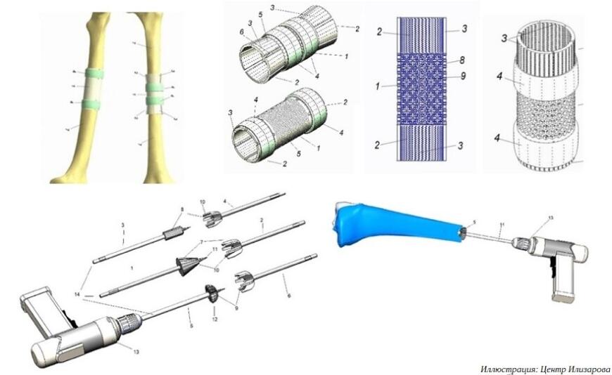 3D-печатный имплантат отмечен золотой медалью выставки «Архимед-2023»