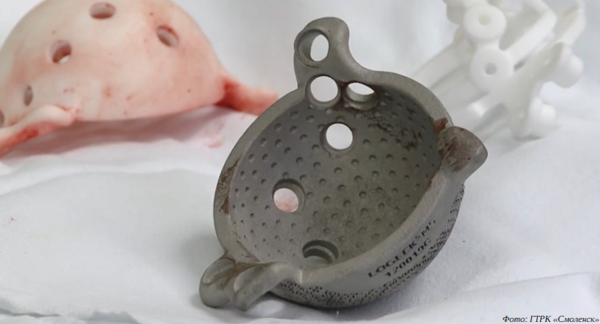 Смоленские врачи провели операцию по установке 3D-печатного эндопротеза