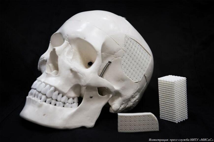Российские и латвийские ученые предложили новый биоактивный наполнитель для 3D-печатных имплантатов
