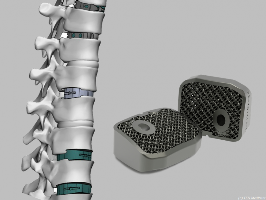 Компания TEN MedPrint наладила 3D-печать межпозвонковых имплантатов