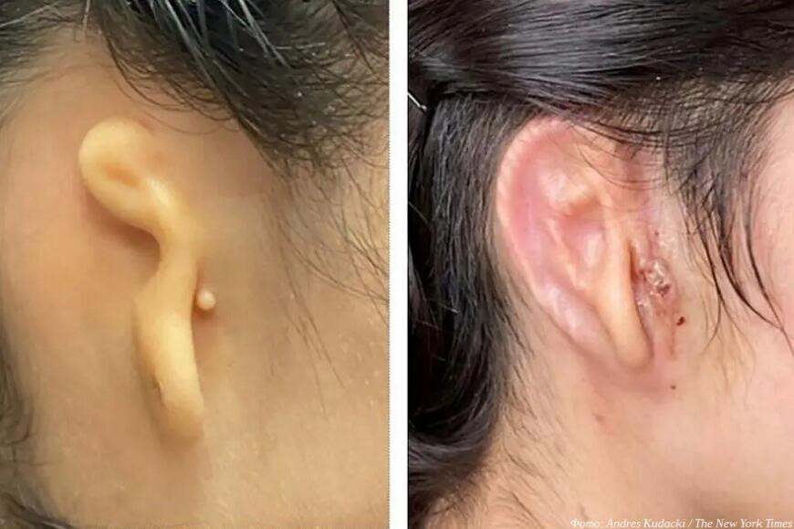 В США провели операцию по вживлению 3D-печатного уха