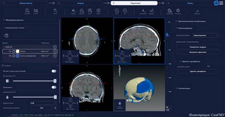 Разработка СамГМУ позволяет эффективно создавать индивидуальные имплантаты для краниопластики
