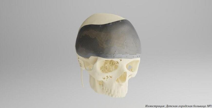 Петербургские хирурги провели уникальную операцию на ребенке с использованием 3D-печатного имплантата