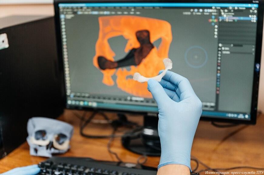 Томские хирурги применяют 3D-печатные полимерные имплантаты