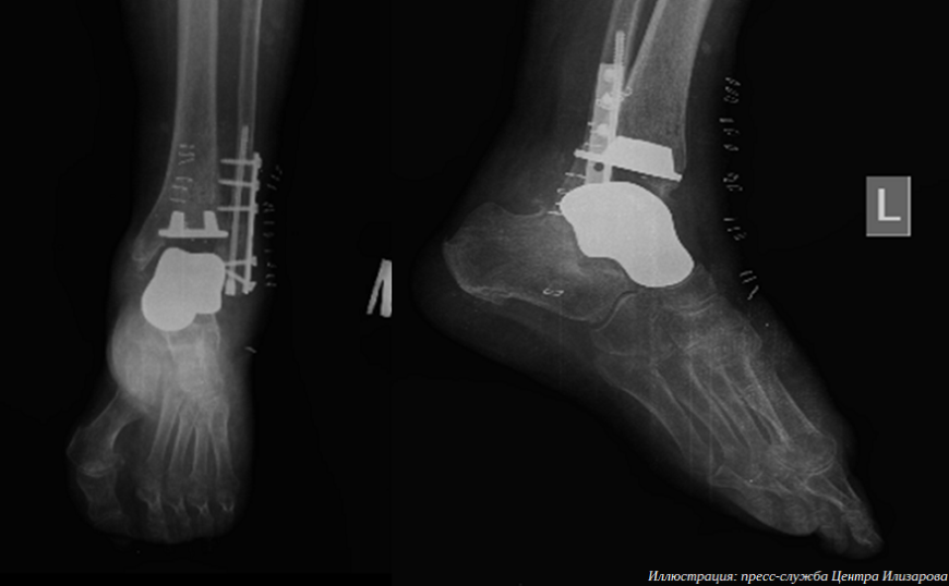 В Центре Илизарова провели операцию по замене таранной кости и голеностопного сустава 3D-печатным протезом