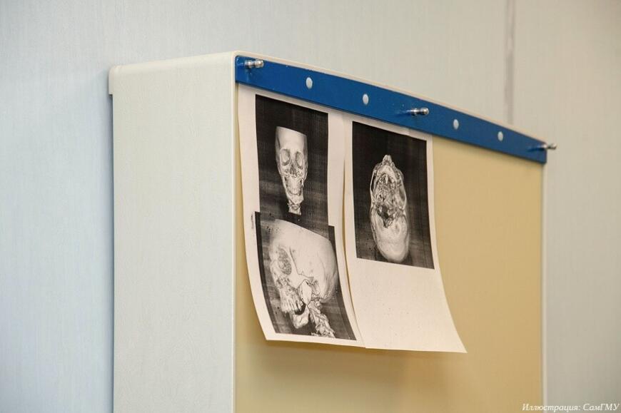 Врачи СамГМУ провели операцию на челюсти с применением 3D-печатного эндопротеза
