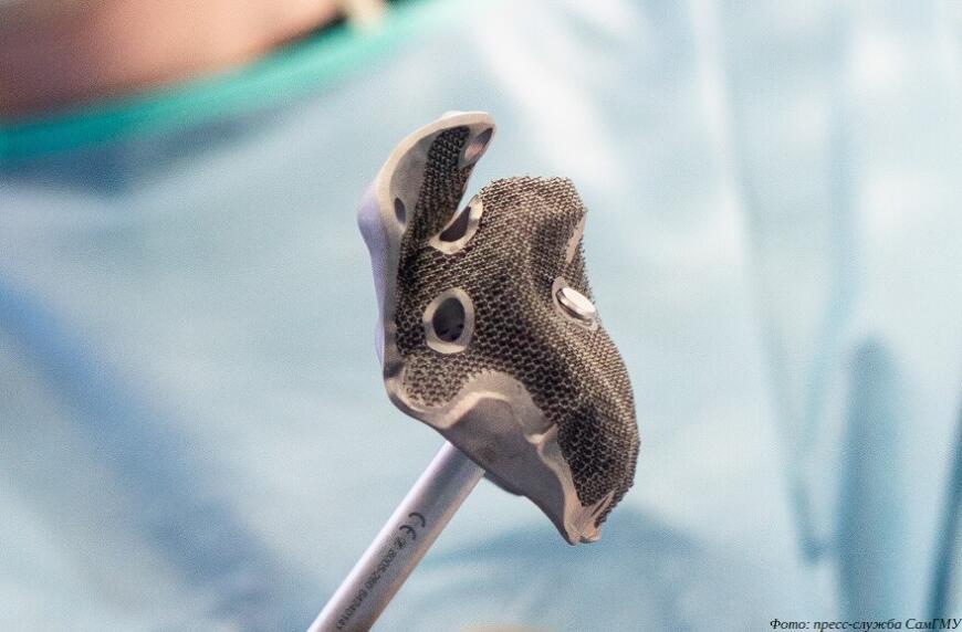 Самарские врачи провели операцию с использованием титанового 3D-печатного имплантата местного производства