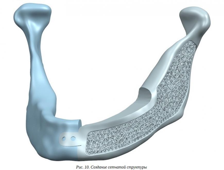 Новое слово в реинжиниринге: создание челюстного имплантата с применением конвергентного моделирования