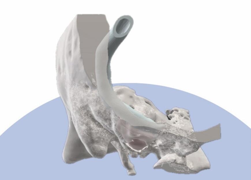 3D-печатные анатомические модели CML AT Medical повысят эффективность хирургических операций