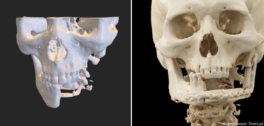 Томские онкологи восстановили челюсть пациента с помощью 3D-печати
