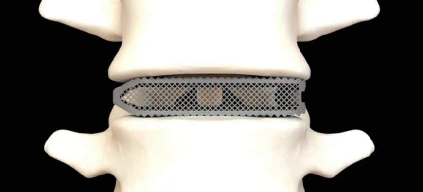 Osseus Fusion Systems предлагает 3D-печатные межпозвонковые имплантаты