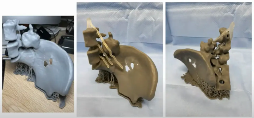 Как сейчас используется 3D-печать в хирургии позвоночника