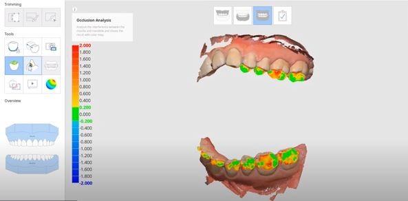 Обзор интраорального 3D-сканера Medit i500